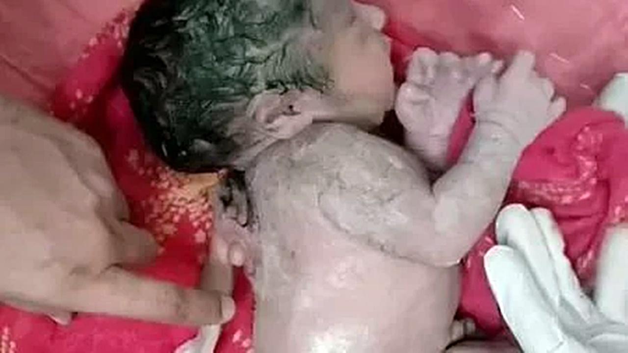 Bebê nasce com 'terceiro braço' nas costas por causa de rara condição médica; entenda