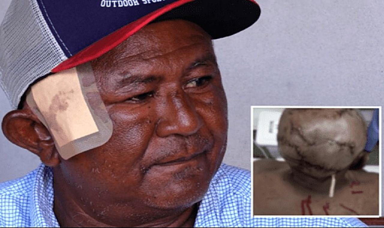 Homem atacado por onça leva mais de 150 pontos na cabeça e nas costas