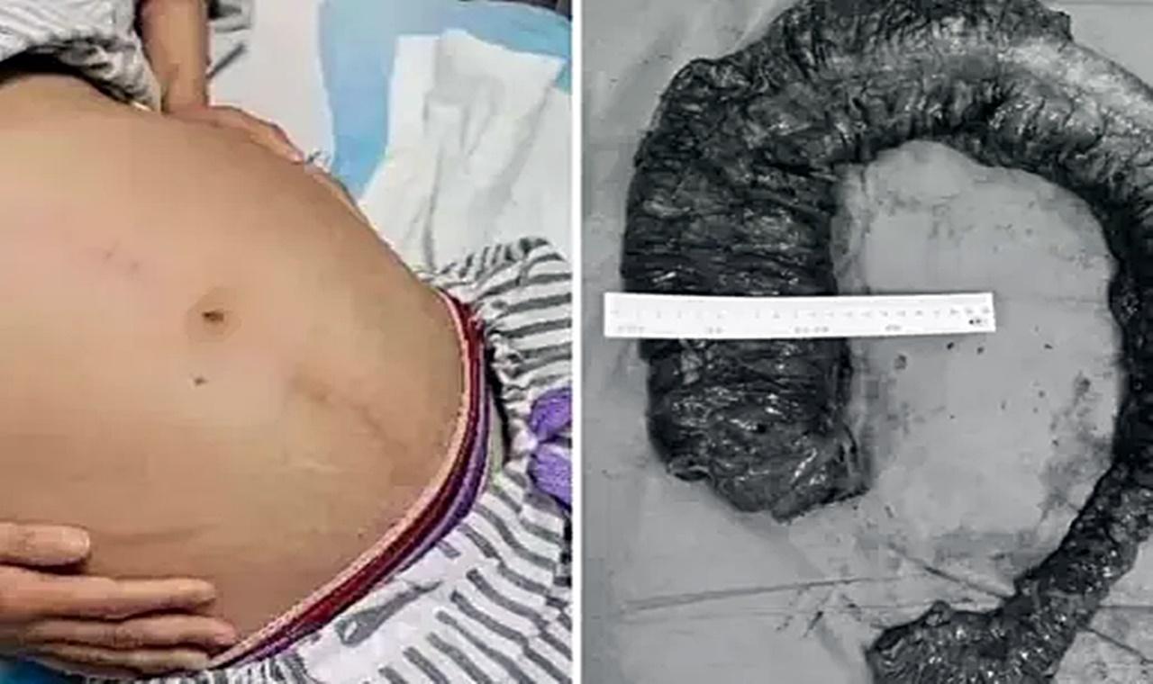 Mulher tem que fazer cirurgia para retirar cocô gigante de 20 kg do intestino