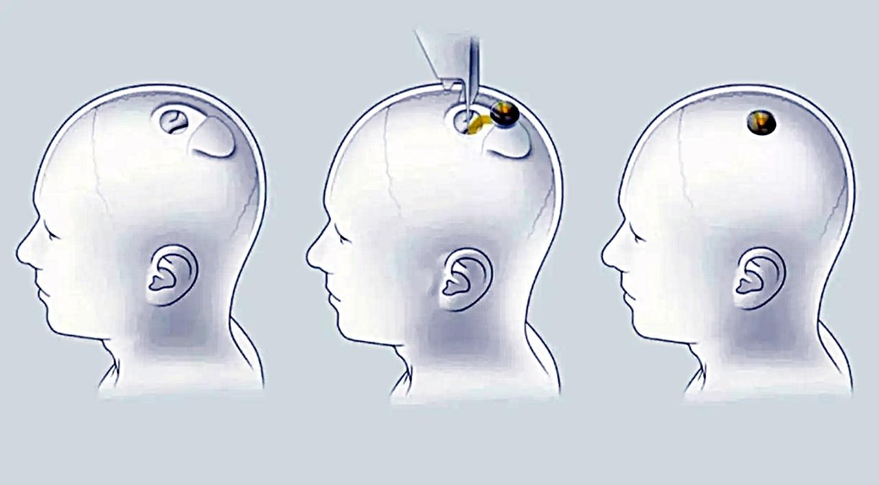 Empresa de Musk está autorizada a testar chips cerebrais em humanos nos EUA