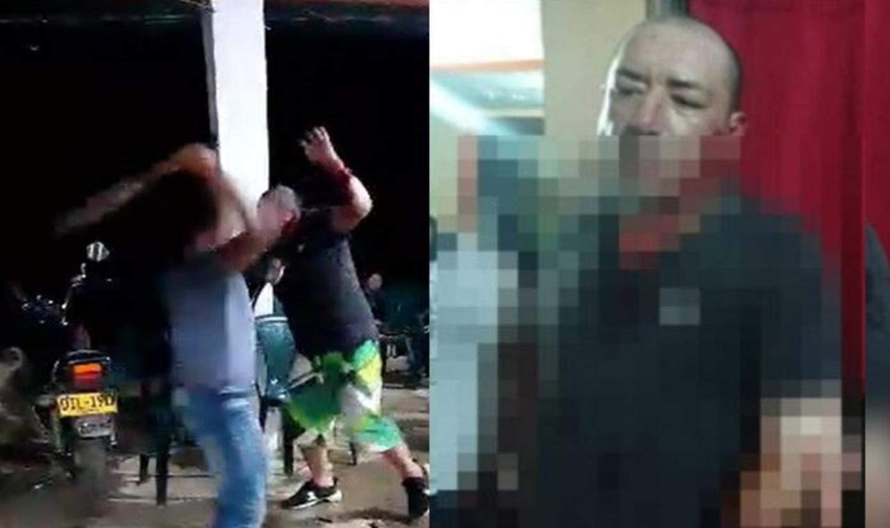 IMAGENS FORTES:  Homem tem braço decepado durante briga de bar; VEJA