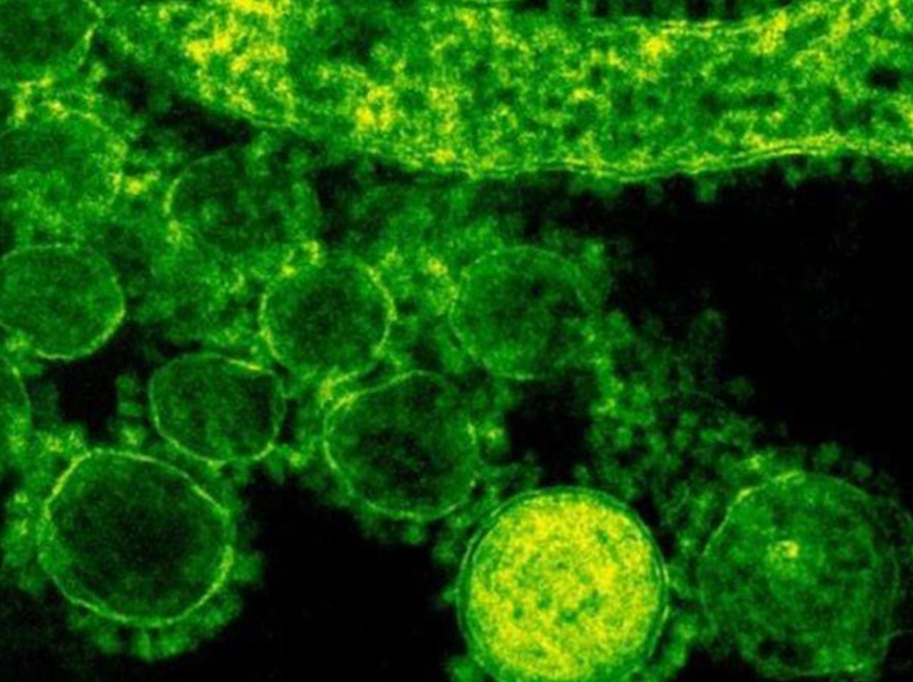 Vírus ‘comedor de ânus’ que mata 30% das pessoas se espalha e gera alerta