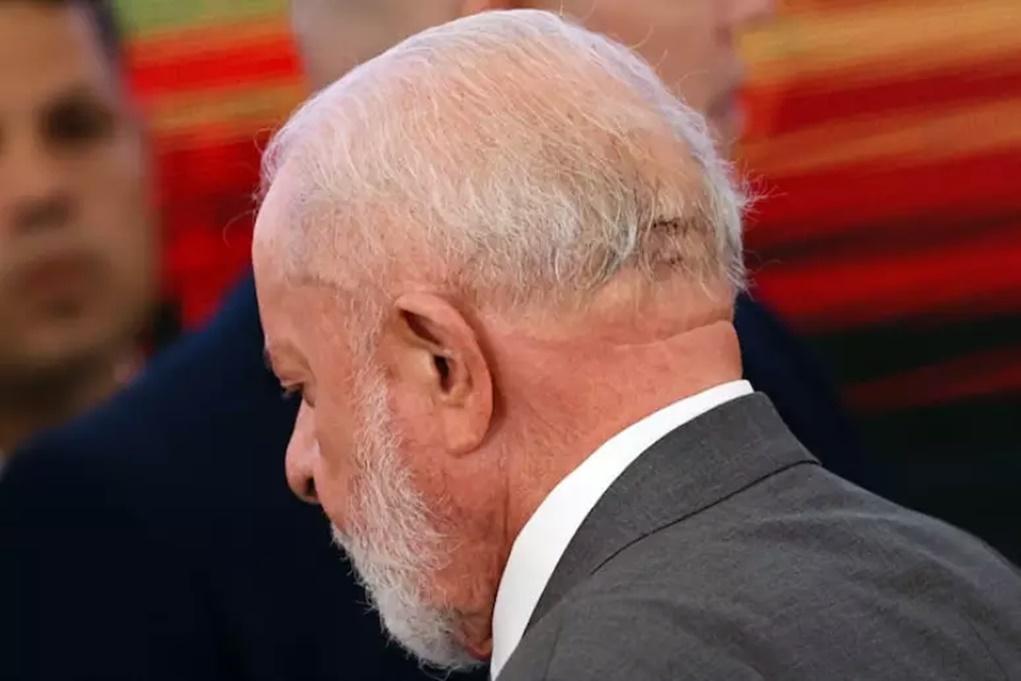 Lula passa por cirurgia em São Paulo após hemorragia intracraniana