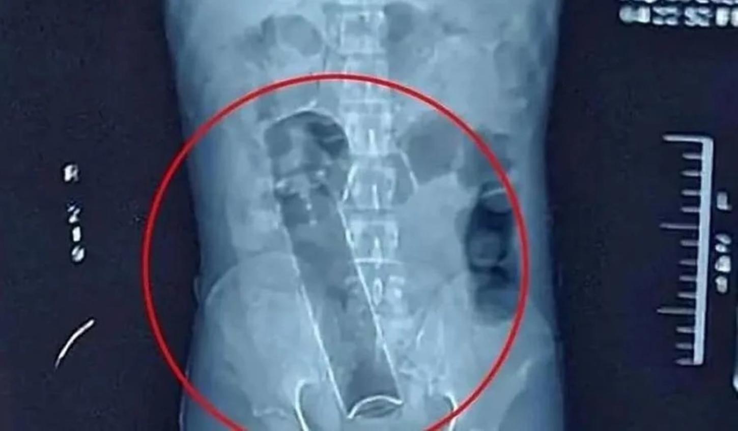 JI-PARANÁ - RONDÔNIA -  Empresário busca atendimento após desodorante ficar preso no ânus 