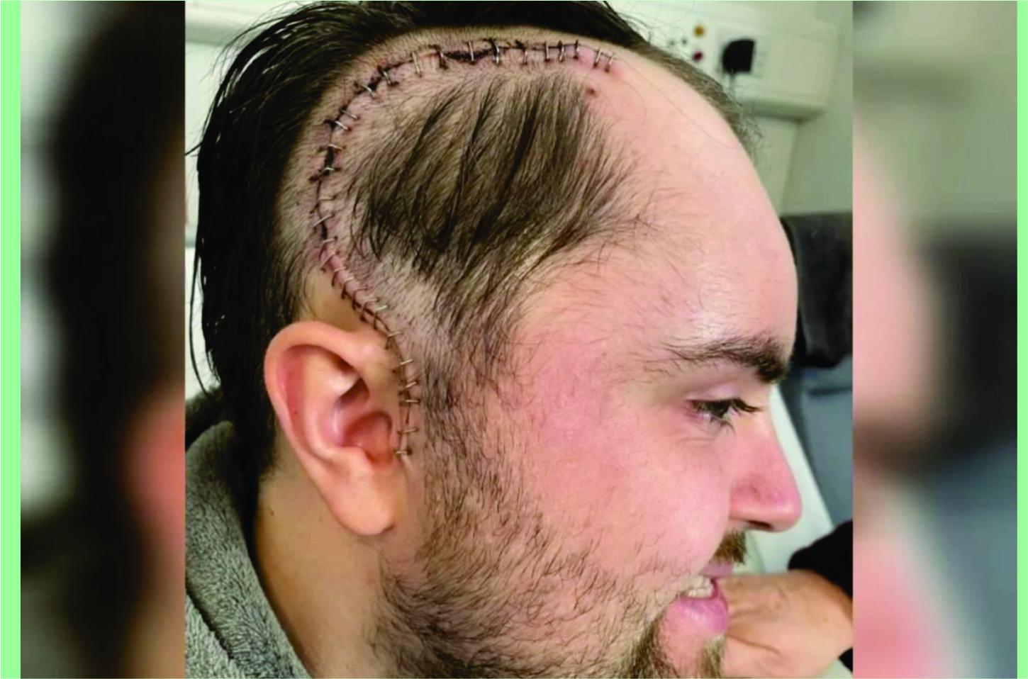 Homem ignora sinais de tumor no cérebro achando ser dor de musculação