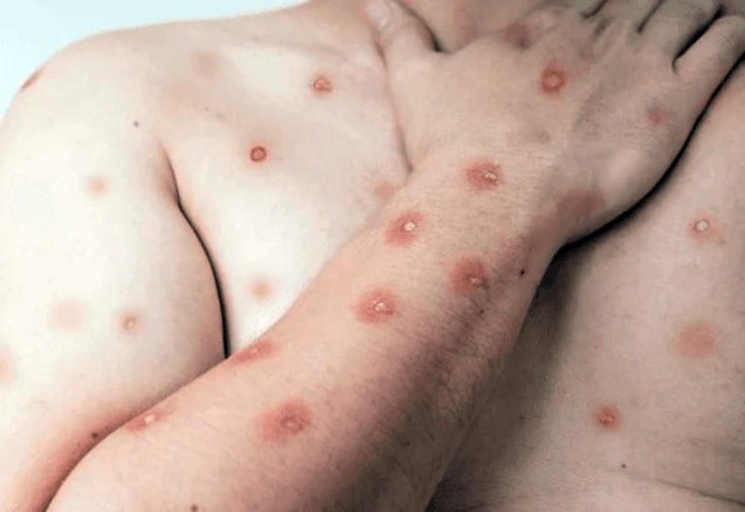 Mpox no Brasil: entenda o que é a doença e se há risco de novo surto