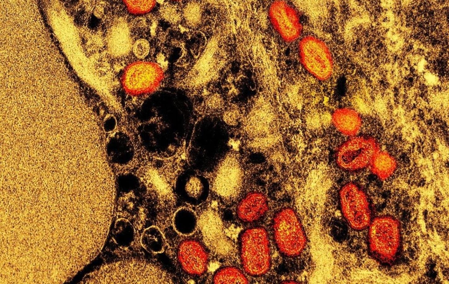 Mpox: 5 novos estados registram casos da doença; total no Brasil chega a 136