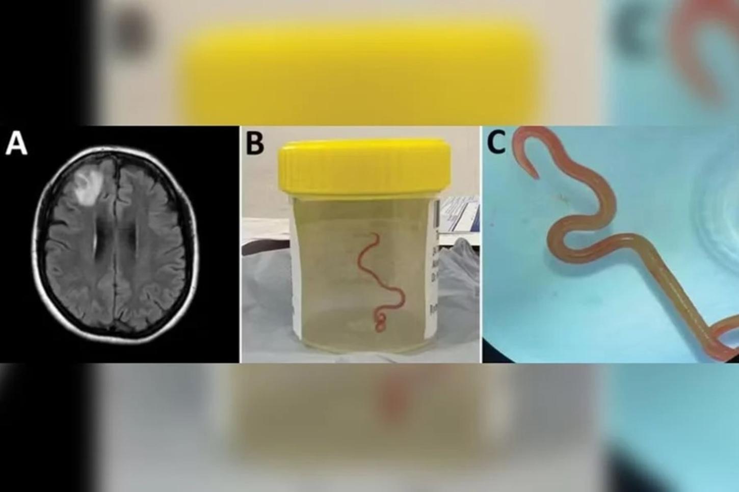 Verme parasita de cobra é encontrado pela 1ª vez no cérebro de humanos